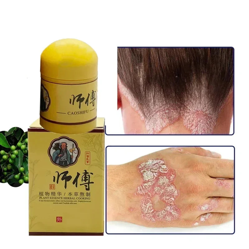 Skin Psoriasis Cream Dermatitis Eczematoid Eczema  Psoriasis Cream Skin Care Cream