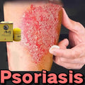 Skin Psoriasis Cream Dermatitis Eczematoid Eczema  Psoriasis Cream Skin Care Cream