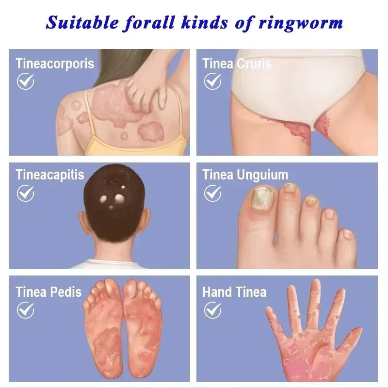 Skin Psoriasis Cream Dermatitis Eczematoid Eczema  Psoriasis Cream Skin Care Cream