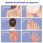 Skin Psoriasis Cream Dermatitis Eczematoid Eczema  Psoriasis Cream Skin Care Cream