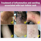 Skin Psoriasis Cream Dermatitis Eczematoid Eczema  Psoriasis Cream Skin Care Cream