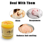 Skin Psoriasis Cream Dermatitis Eczematoid Eczema  Psoriasis Cream Skin Care Cream