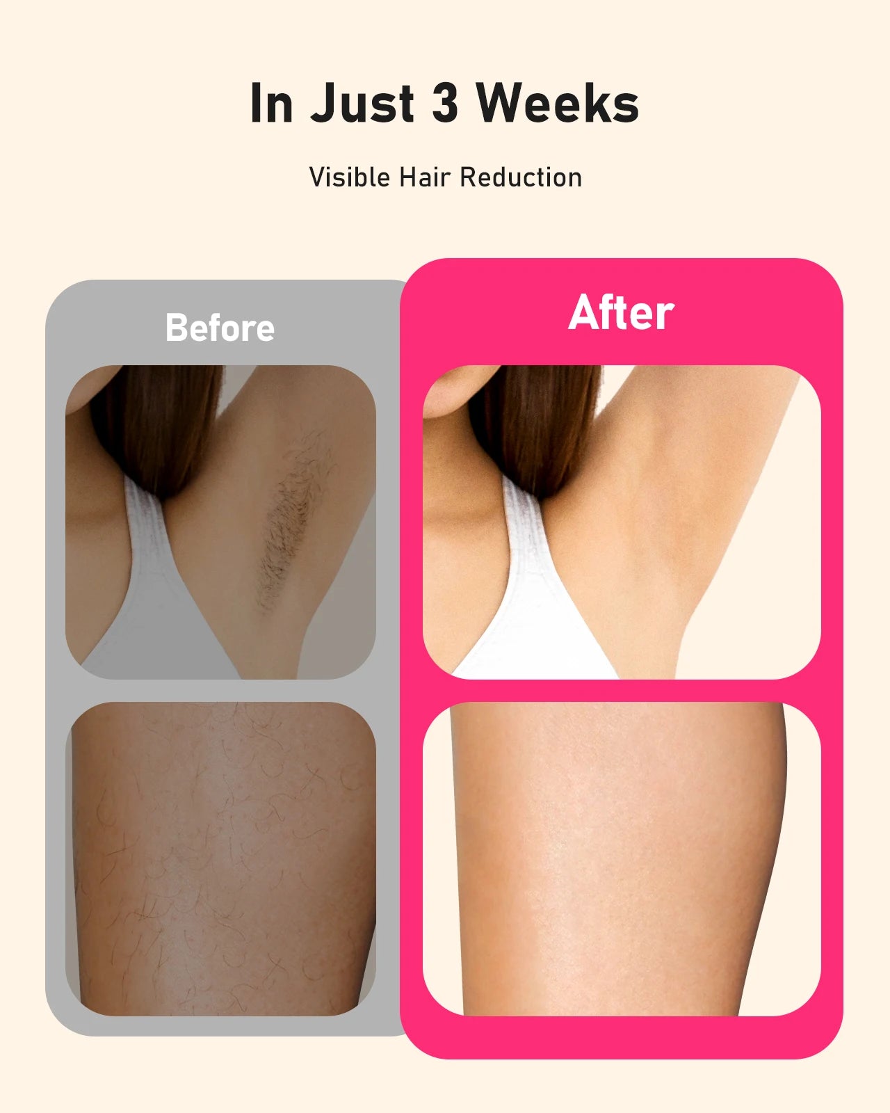 Laser Hair Removal Fast flashes 3 In 1 IPL