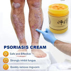 Skin Psoriasis Cream Dermatitis Eczematoid Eczema  Psoriasis Cream Skin Care Cream