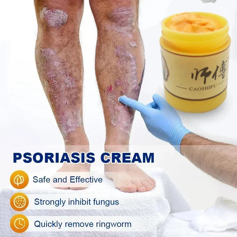 Skin Psoriasis Cream Dermatitis Eczematoid Eczema  Psoriasis Cream Skin Care Cream